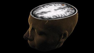 Σχιζοφρένεια: Πώς επηρεάζει όλο το σύστημα επικοινωνιών του εγκεφάλου