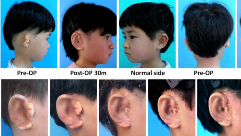 Επιστήμονες δημιουργούν νέα αυτιά για παιδιά με δυσμορφία
