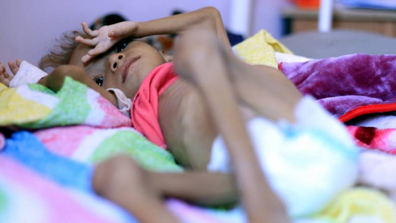 Υεμένη: Το κορίτσι-σύμβολο του λιμού πέθανε σε ηλικία 7 ετών