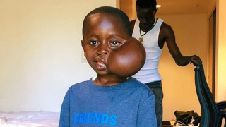Ταξίδι ελπίδας με τραγικό τέλος: Δεν τα κατάφερε το αγοράκι από το Κονγκό με τον όγκο στο πρόσωπο