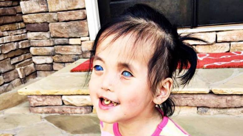 Συγκινεί η 5χρονη με τα «κρυστάλλινα» μάτια: Της τα αφαίρεσαν για να «λυτρωθεί»