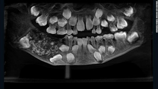 Απίστευτο και όμως αληθινό: 7χρονο αγόρι είχε 526 δόντια μέσα στο στόμα του!