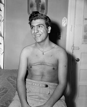 15 Φεβρουαρίου 1953. Ο Τσαρλς (Τσακ) Μόουζες, 16 ετών, δείχνει τα χειρουργικά σημάδια από την επέμβαση που έγινε στην καρδιά του. Χρησιμοποιώντας πλαστική χειρουργική και μια μηχανική καρδιά που τον κράτησε ζωντανό, οι γιατροί επιδιόρθωσαν μια χαλασμένη β