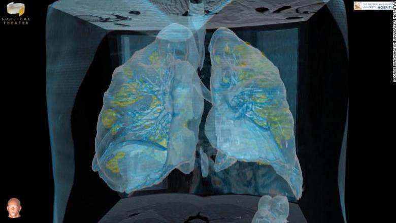 Κορωνοιός: 3D βίντεο αποκαλύπτει τις βλάβες που προκαλεί ο ιός στους πνεύμονες