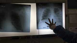Κορωνοϊός: Πρωτοποριακή μελέτη αποκαλύπτει την αθέατη ζημιά που προκαλεί στους πνεύμονες