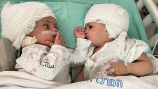 Σπάνια εγχείρηση στο Ισραήλ: Σιαμαία ενωμένα στο κεφάλι είδαν για πρώτη φορά το ένα το άλλο