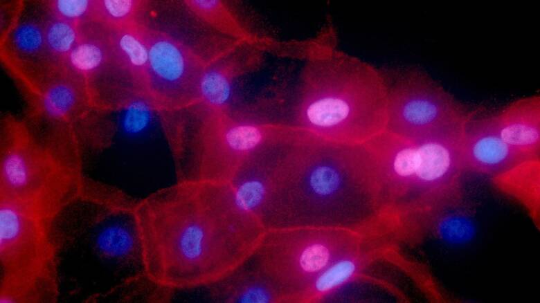 «Πρωτάκουστα» ποσοστά επιβίωσης έδειξαν τα πρώτα αποτελέσματα φαρμάκου για τον καρκίνο του στήθους