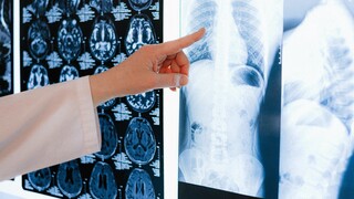 Καρκίνος του πνεύμονα: Τι συμβουλεύουν οι επιστήμονες