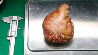 Στο μέγεθος… γκρέιπφρουτ: Αυτή είναι η μεγαλύτερη πέτρα νεφρού που έχει αφαιρεθεί ποτέ