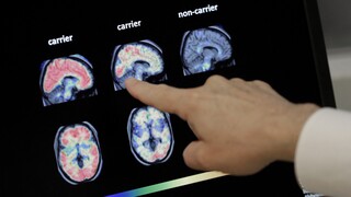 Nέο φάρμακο - ορόσημο στον αγώνα κατά του Αλτσχάιμερ δίνει ελπίδες - Τι δείχνουν οι έρευνες